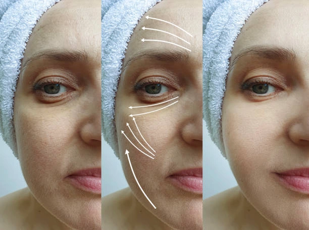 عمليات شد الوجه في سوريا