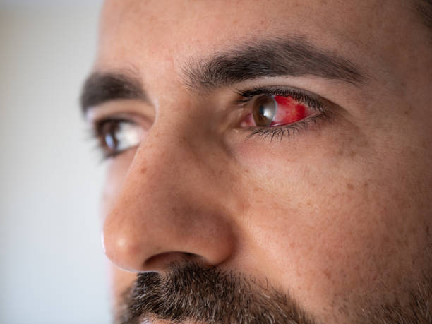 أشهر أمراض الشبكية وأعراضها التحذيرية