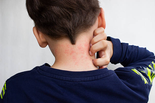 الحساسية الجلدية عند الأطفال