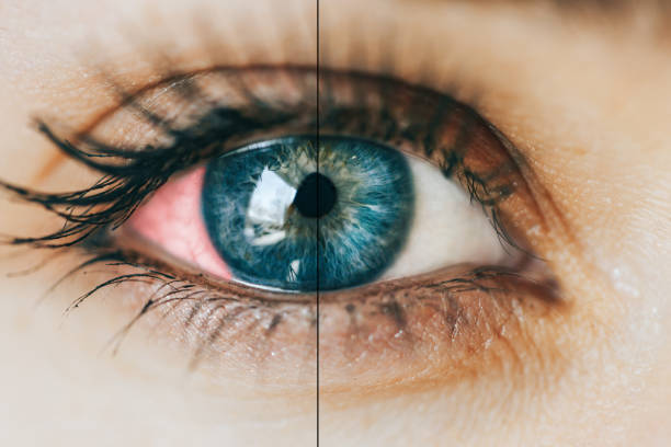 أعراض أمراض العيون 