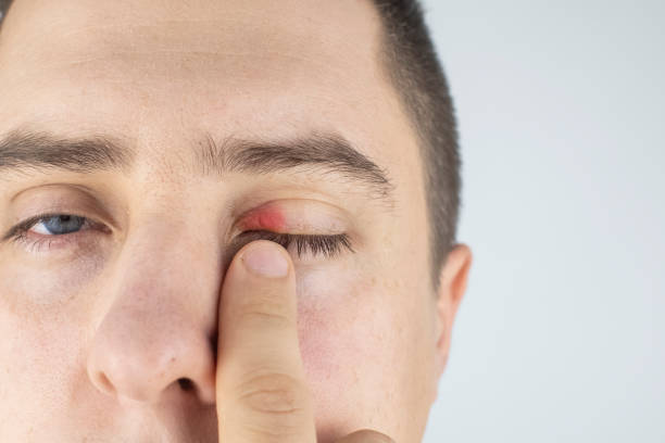 الآثار الجانبية المحتملة بعد الليزك